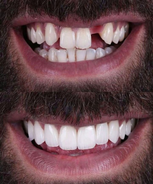 روکش موقت